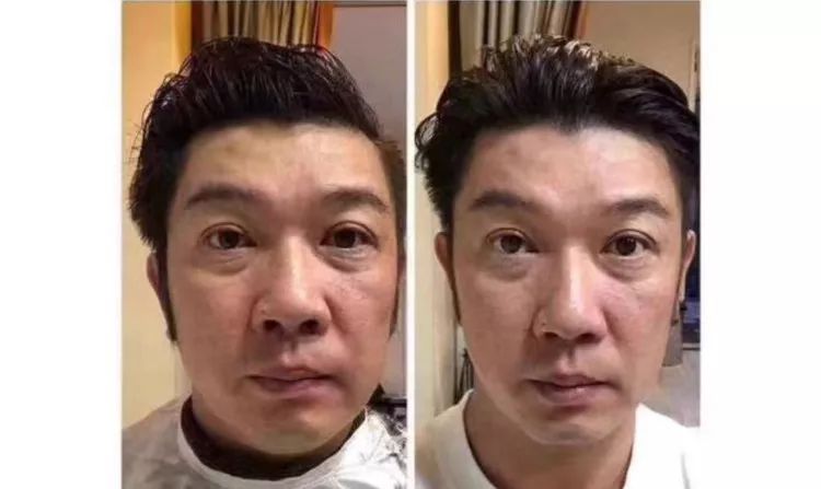 不削骨改变脸型,不削骨变脸型