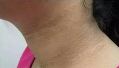 男孩子脖子黑洗不掉怎么办,男孩脖子老是不舒服是怎么回事