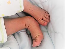 刚出生就要打石膏?硬核医生手工打造矫形器治疗足外翻