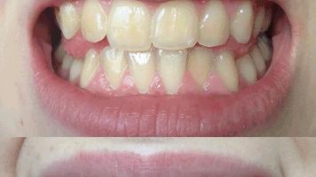 便宜哭了!日本人都在用的变态牙刷,竟然比洗牙还白,牙垢、牙龈出血全解决,嘴巴里脏东西洗出来后,太清爽了