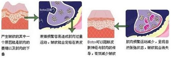 外用涂抹式肉毒素可以祛皱纹吗,去皱纹的肉毒素一年打几次为佳