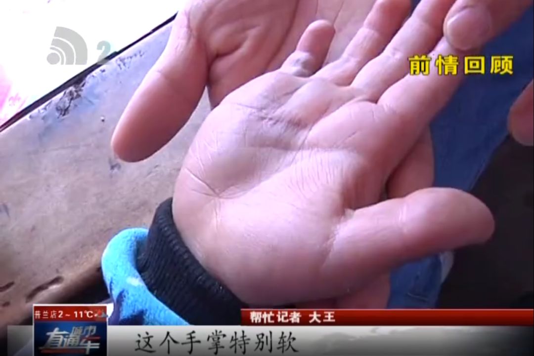 帮忙大小王|留守儿童手肿像水球大王帮忙查明病因