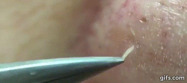 痘痘闭口里面有油脂,鼻子上的痘痘是青春痘还是粉刺