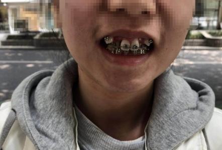 女子牙齿矫正疗程未完诊所老板疑似“卷款跑路”