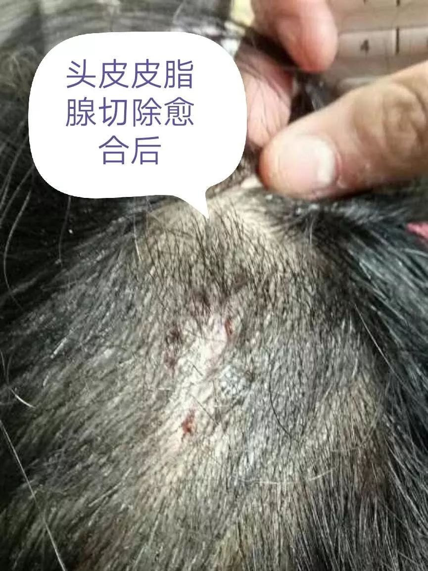 小小黑痣该不该治？该如何治？
