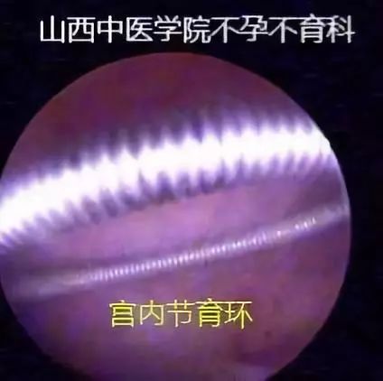 不孕症宫腔镜,不孕症的微创手术