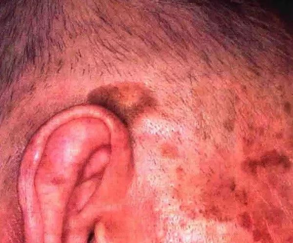 脱发属于什么问题,脱发是什么原因造成中老年