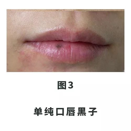口腔里和嘴唇长满了黑点,口唇上的黑斑要引起重视