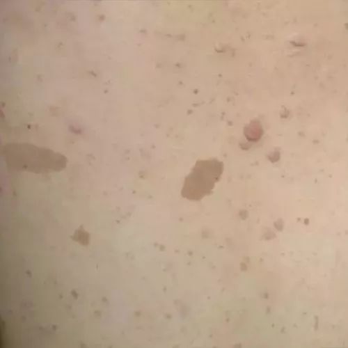 咖啡斑为什么叫咖啡,咖啡斑是喝咖啡引起的吗