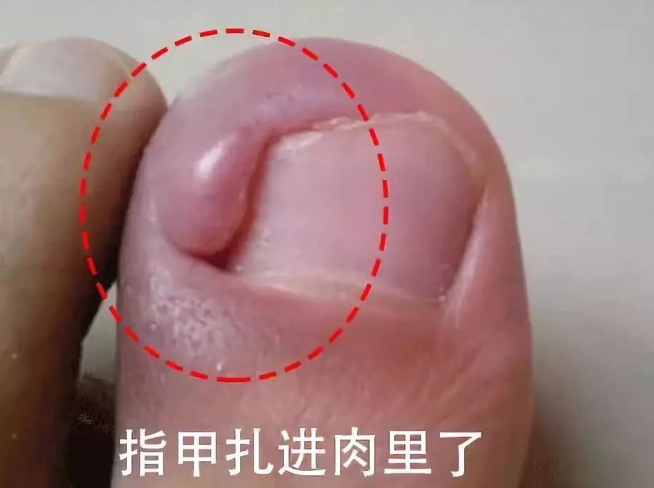 趾甲扎进肉里了，一碰就痛？用它一贴，1分钟止痛，趾甲往外长，再也不扎痛了！