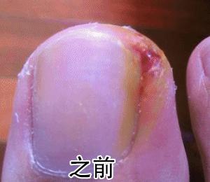 趾甲扎进肉里了，一碰就痛？用它一贴，1分钟止痛，趾甲往外长，再也不扎痛了！