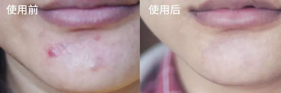 战痘神器祛痘效果怎么样,战痘神器推荐