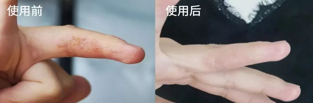 战痘神器祛痘效果怎么样,战痘神器推荐