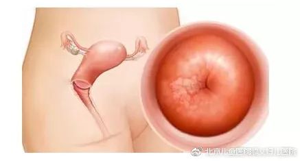 肿瘤防治宣传周科普|“产后”遇上“宫颈癌”——警惕妊娠期宫颈癌