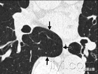 胸部解剖及常见疾病影像表现,胸部影像学基础知识