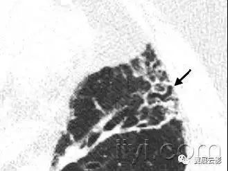 胸部解剖及常见疾病影像表现,胸部影像学基础知识