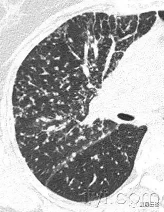 胸部解剖及常见疾病影像表现,胸部影像学基础知识