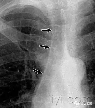 胸部解剖及常见疾病影像表现,胸部影像学基础知识