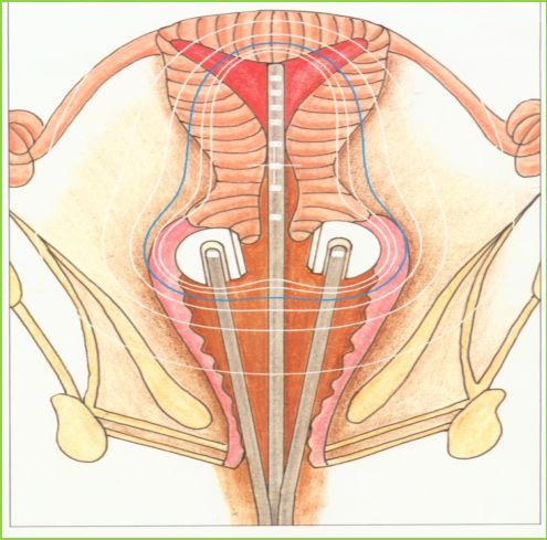 “隐形的手术刀”—揭秘宫颈癌的放射治疗(上)