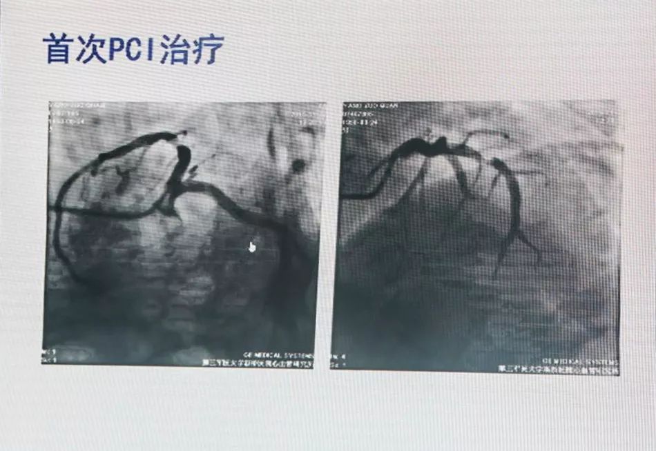 CCIF2019丨黄岚教授：急性/亚急性支架血栓的处理策略