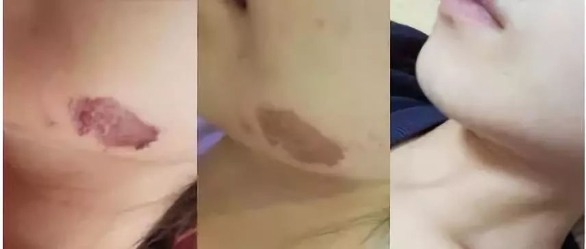 疤痕彻底消失新技术,疤痕淡化修复新技术