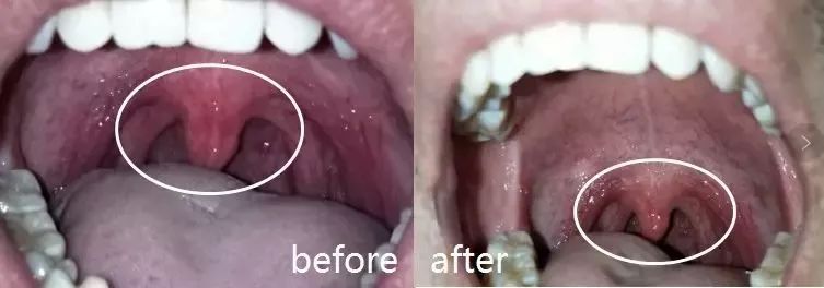 牙龈上火、红肿，还口臭？香港人用了91年的中药牙膏，消炎抑菌，让你刷出一口健康好牙