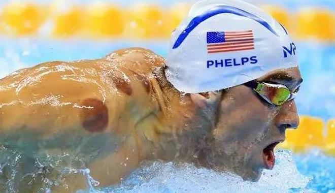 来自东方的神秘力量火罐,火罐疗法