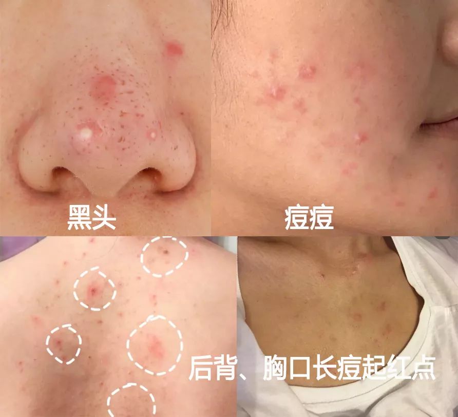 皮肤清洁出黑色的东西,皮肤挤出白色膏状很臭怎么办