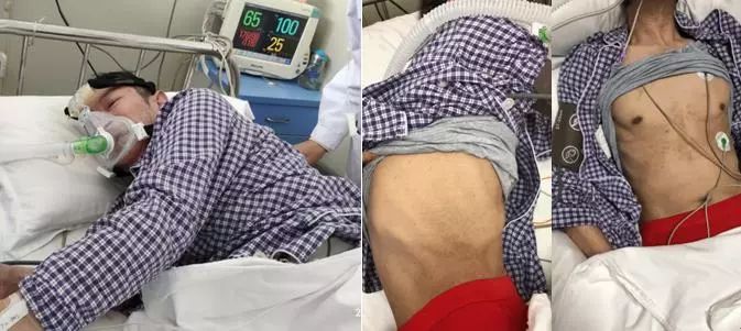 支气管镜热消融术治疗慢阻肺,西京医院支气管镜