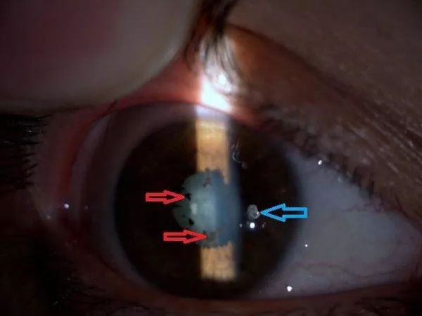 双侧骶髂关节炎会导致葡萄膜炎吗,骶髂关节炎伴发葡萄膜炎