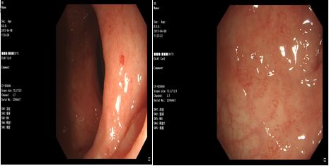 溃疡性结肠炎的诊疗过程医生笔记,溃疡性结肠炎协和