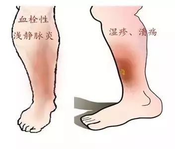 静脉曲张科普视频,关于下肢静脉曲张你知道多少