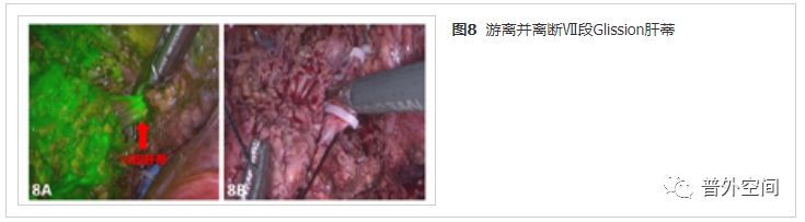 吲哚菁绿荧光引导腹腔镜解剖性肝脏Ⅶ段切除手术流程