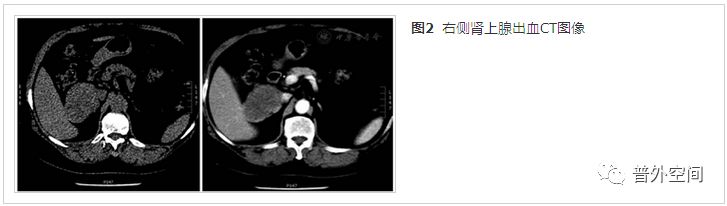 肾上腺出血病因及治疗,肾上腺出血什么意思