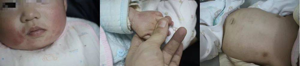 孩子湿疹总不好？医生见到都心疼了……