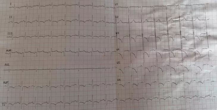 亚急性心内膜炎有蛋白尿吗,loeffler心内膜炎发病概率