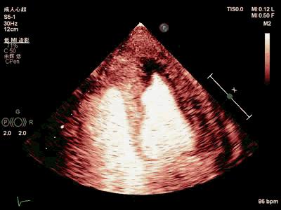 亚急性心内膜炎有蛋白尿吗,loeffler心内膜炎发病概率