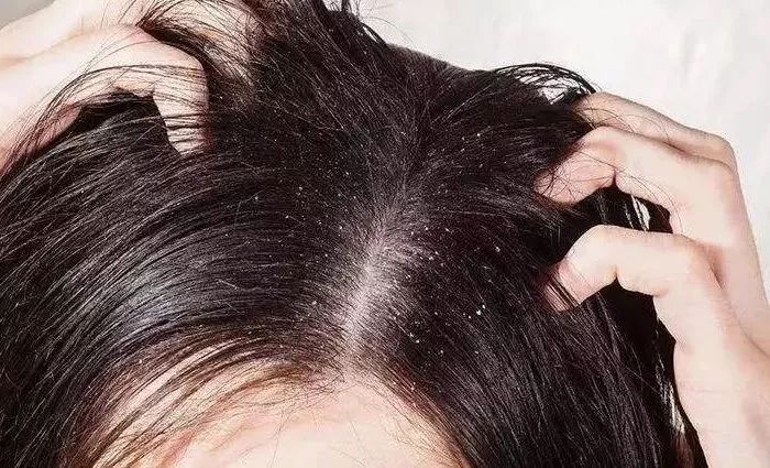 头皮除螨虫神器哪种好用,头皮除螨推荐控油产品吗