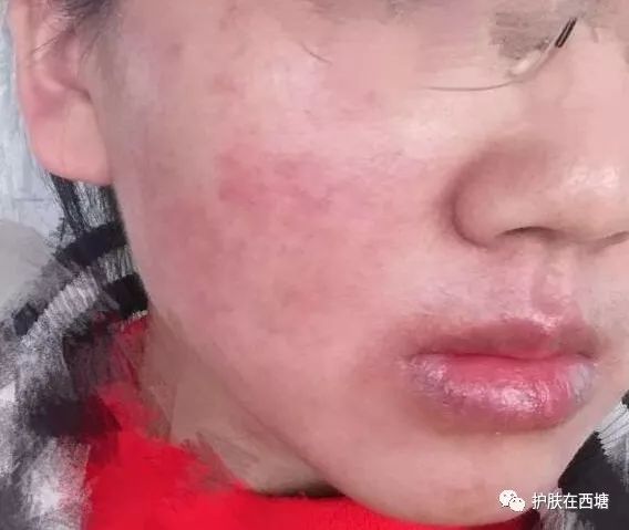 面部皮肤病科普,皮肤科普激素依赖性皮炎