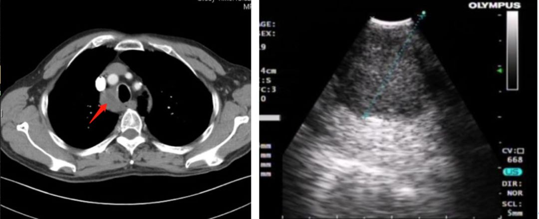 纵隔淋巴结肿大和肺结核有关吗,纵隔淋巴结肿大诊断为肺结核
