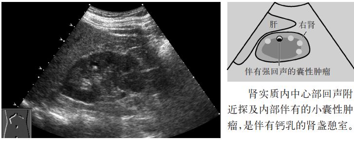 肾盏憩室和肾囊肿b超表现,肾盏憩室误诊肾囊肿案例