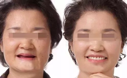 缺牙修复补贴政策,缺牙补牙补贴