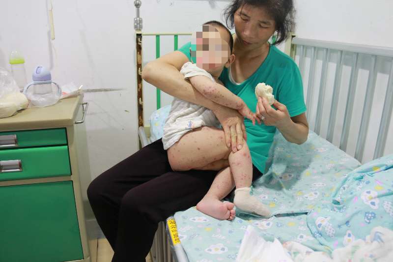 得手足口病,得手足口病的概率是多少