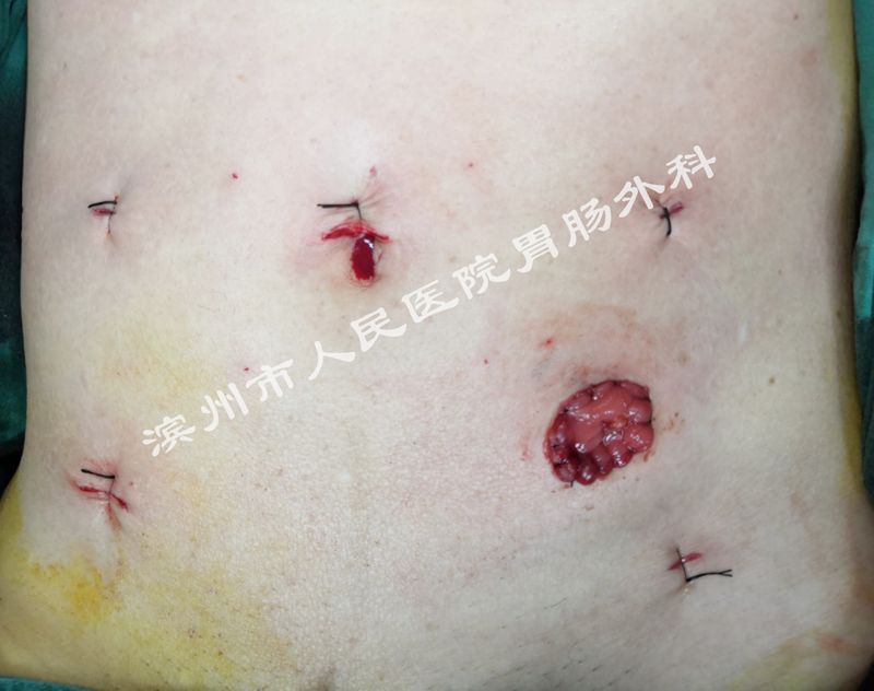 结直肠恶性肿瘤腹腔镜手术,结直肠肿瘤的外科微创治疗