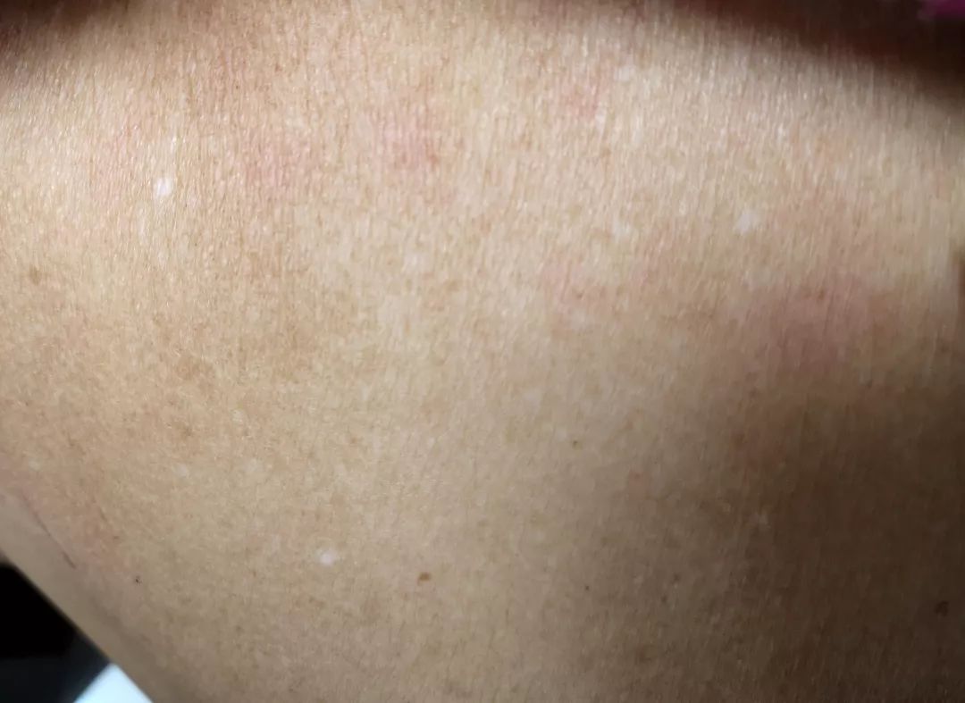 白色花斑糠疹,白色糠疹需要与哪些疾病相鉴别