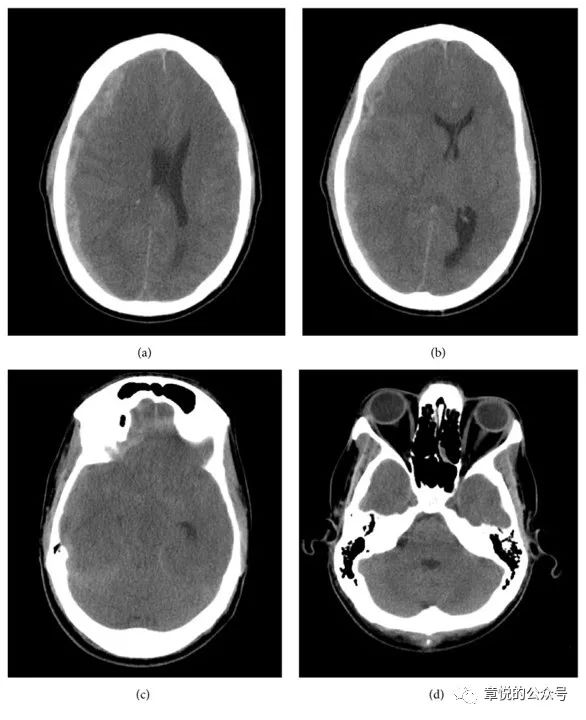 「章悦故事汇」华山“一针灵”