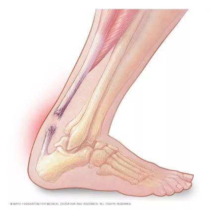 杜兰特汤普森跟腱断裂影响有多大,杜兰特跟腱断裂为什么还那么厉害