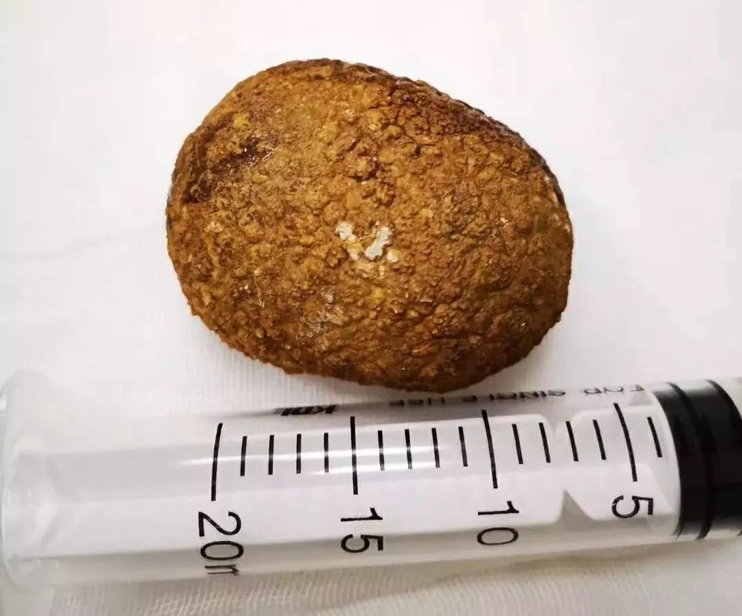 70岁老人前列腺肥大膀胱结石,膀胱巨大结石的症状