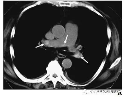 ct平扫肺部能查出是哮喘吗,ct平扫肺结节准确吗