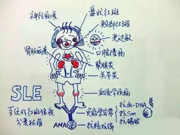 临床可期：间充质干细胞治疗系统性红斑狼疮机理获揭秘